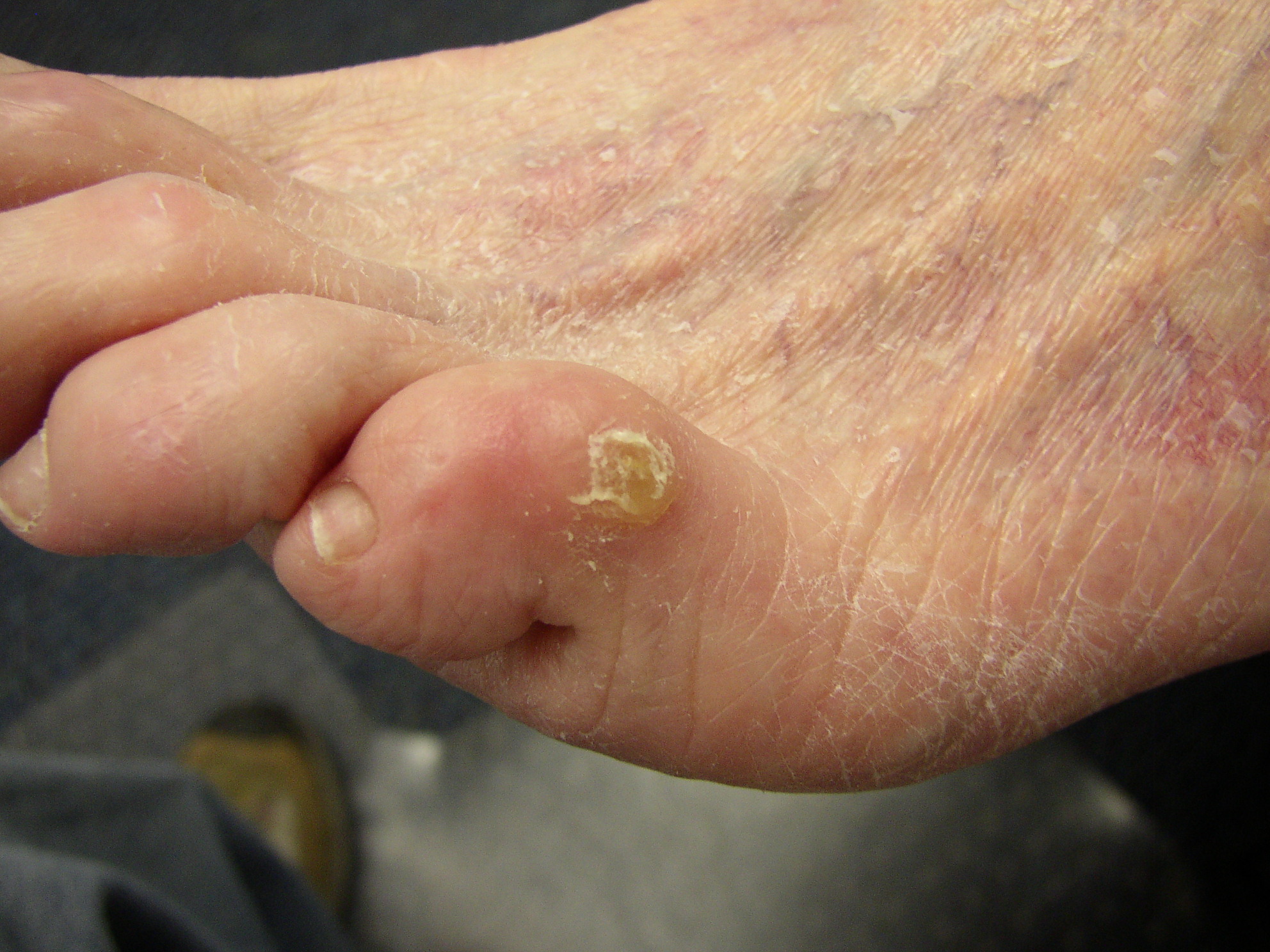 bunion callus